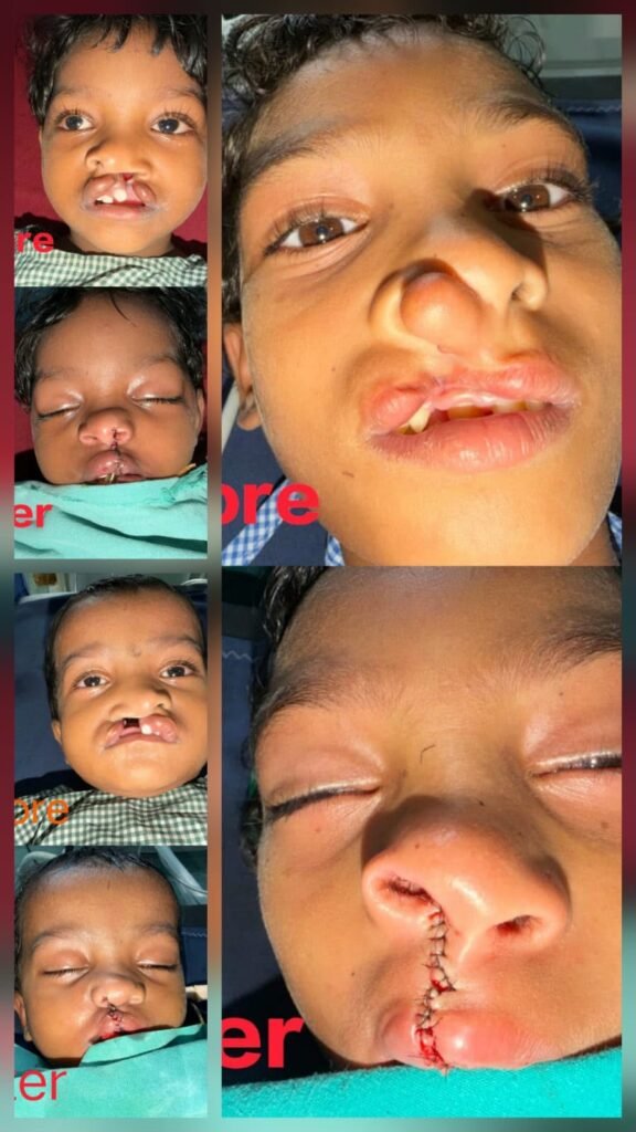 चिरायु योजना से उपचार के बाद बच्चे और परिवार